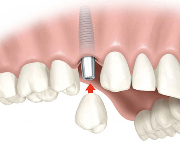 Dentalna oprema za implantologiju